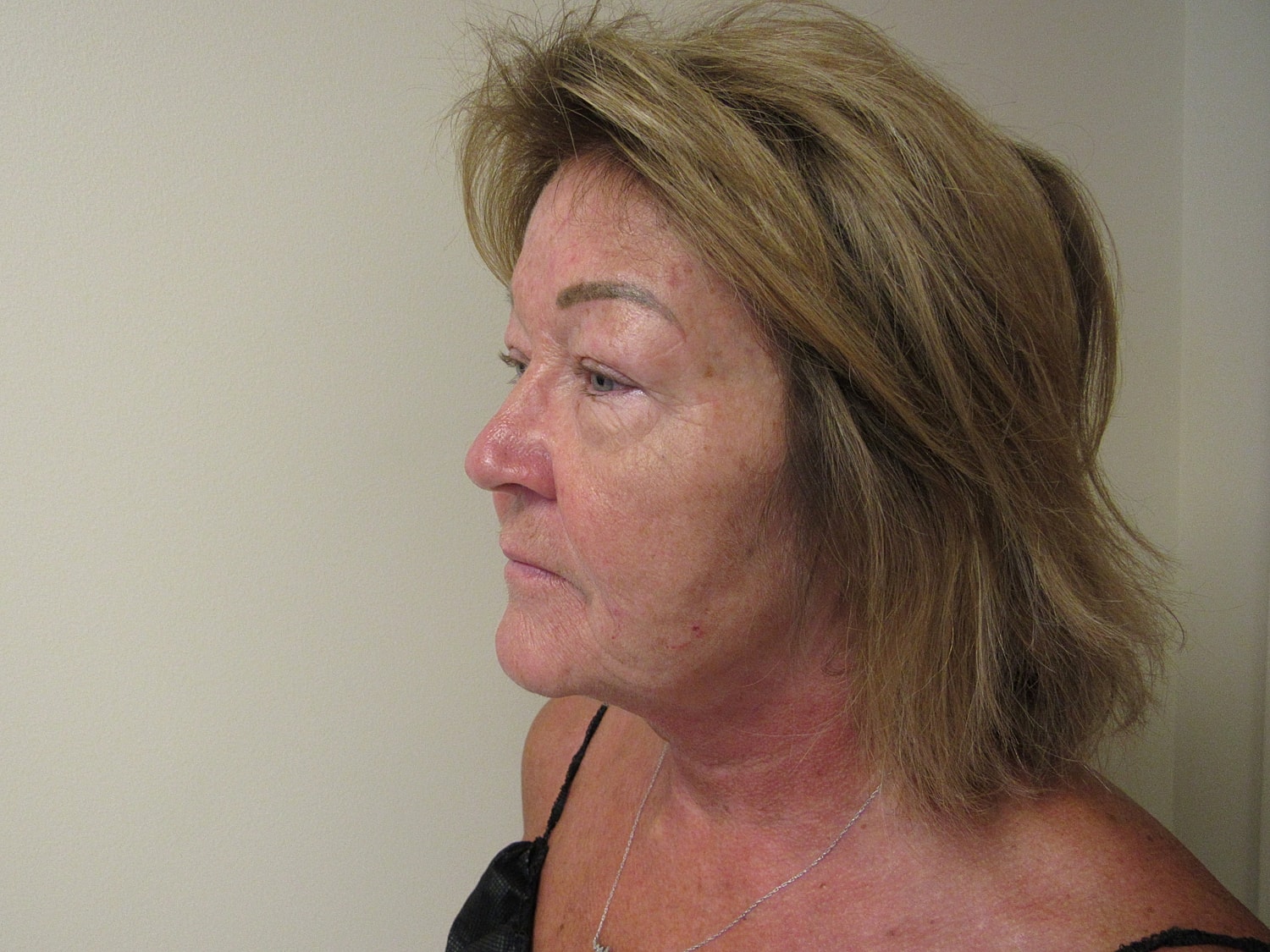 Fat Grafting and Filler Before & After