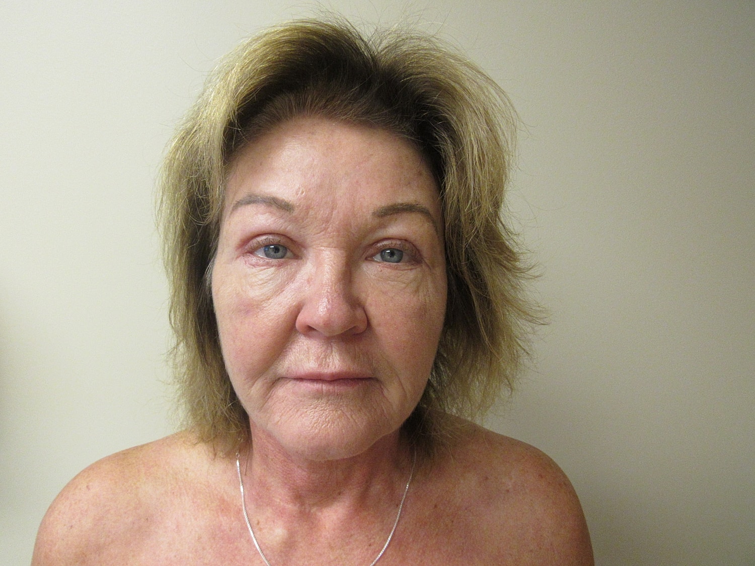 Fat Grafting and Filler Before & After