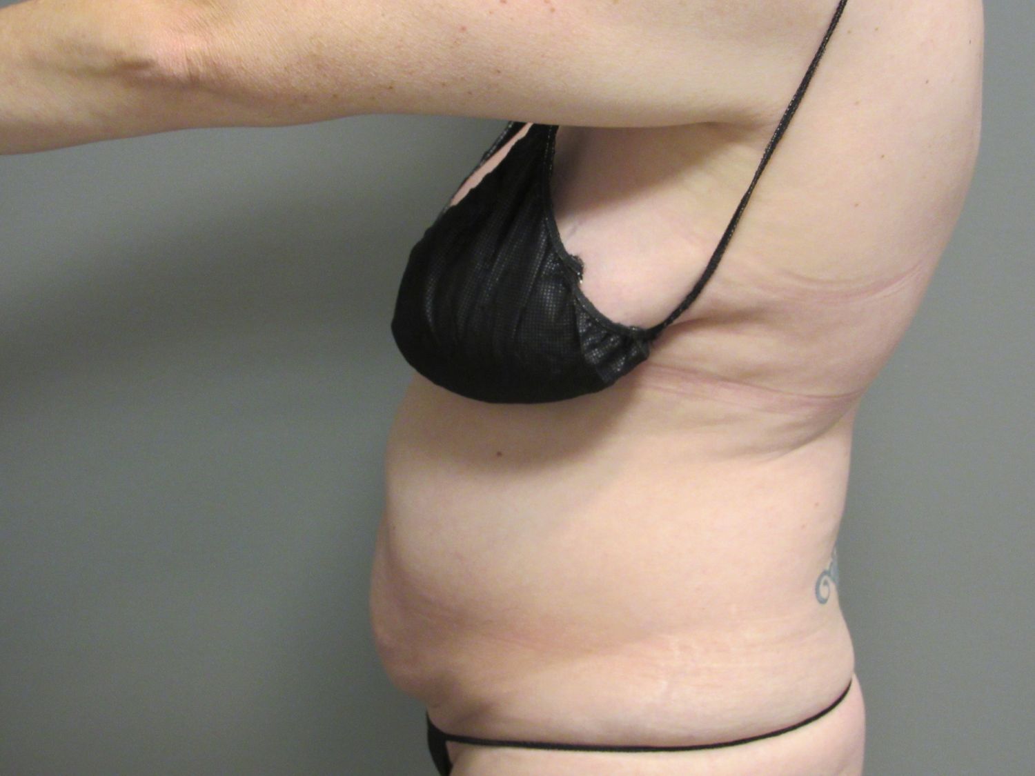 Tummy Tuck Before & After