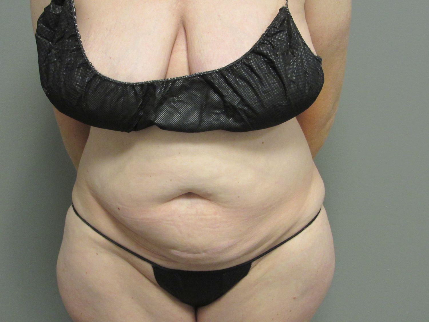 Tummy Tuck Before & After