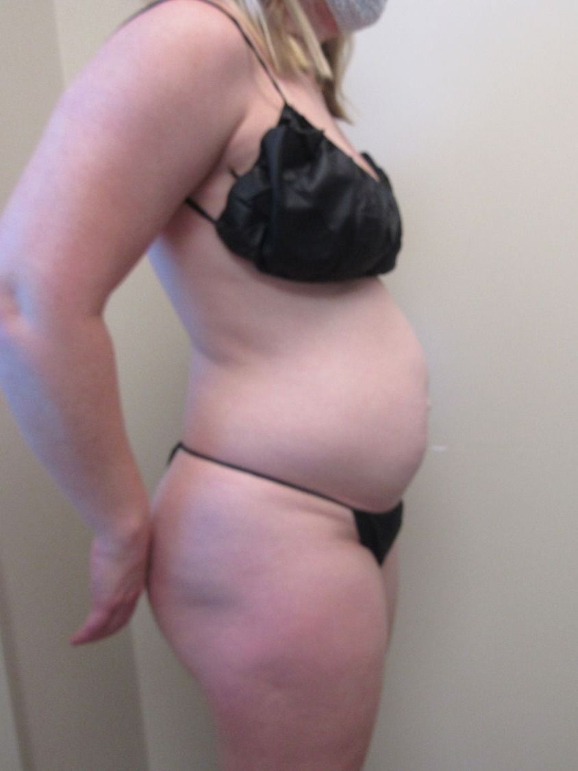 Tummy Tuck Before & After