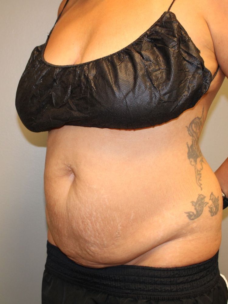 Tummy Tuck Before & After