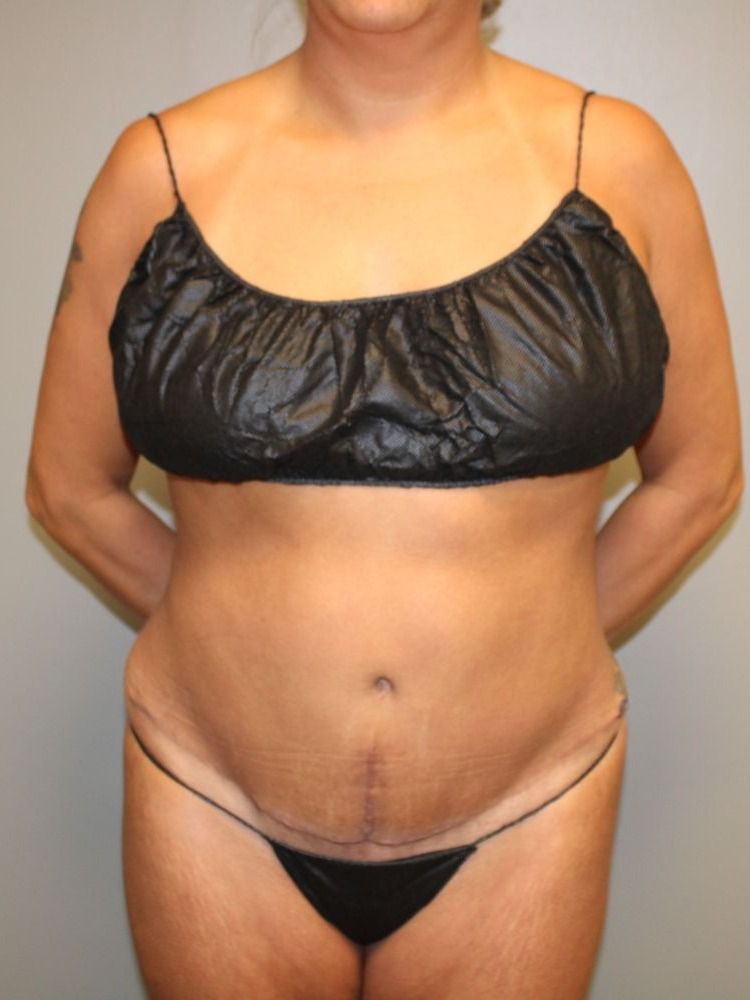 Tummy Tuck Before & After