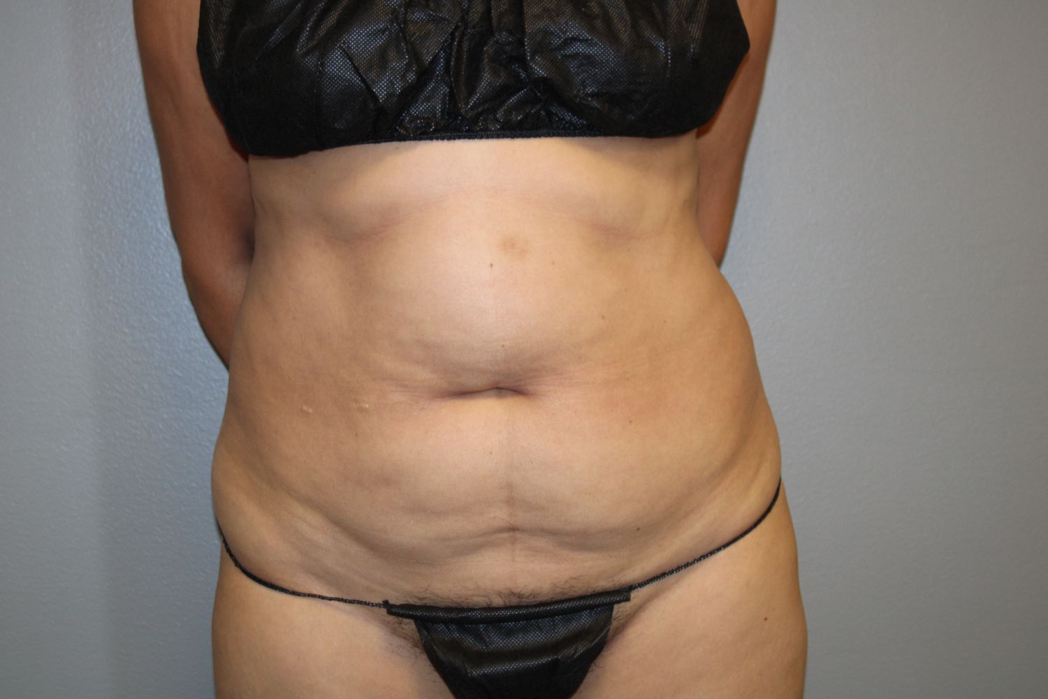 Tummy Tuck Before & After