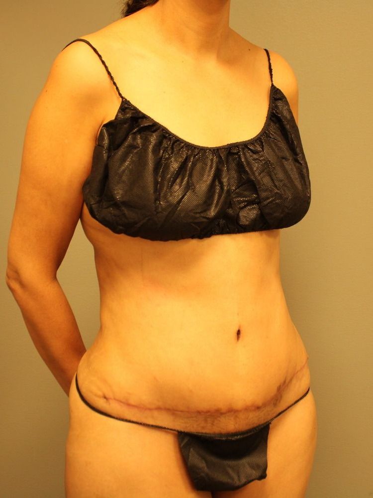 Tummy Tuck Before & After