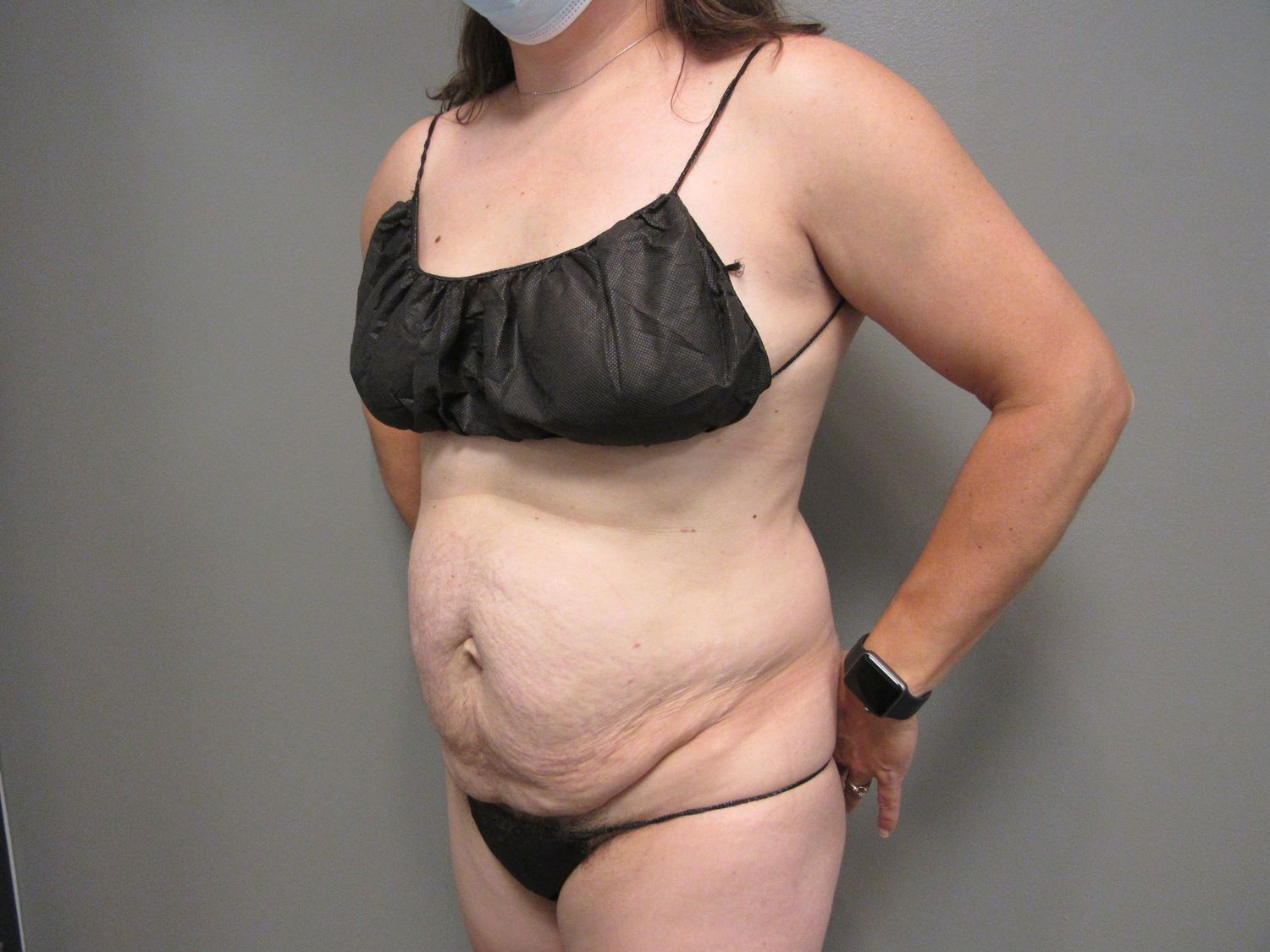 Tummy Tuck Before & After