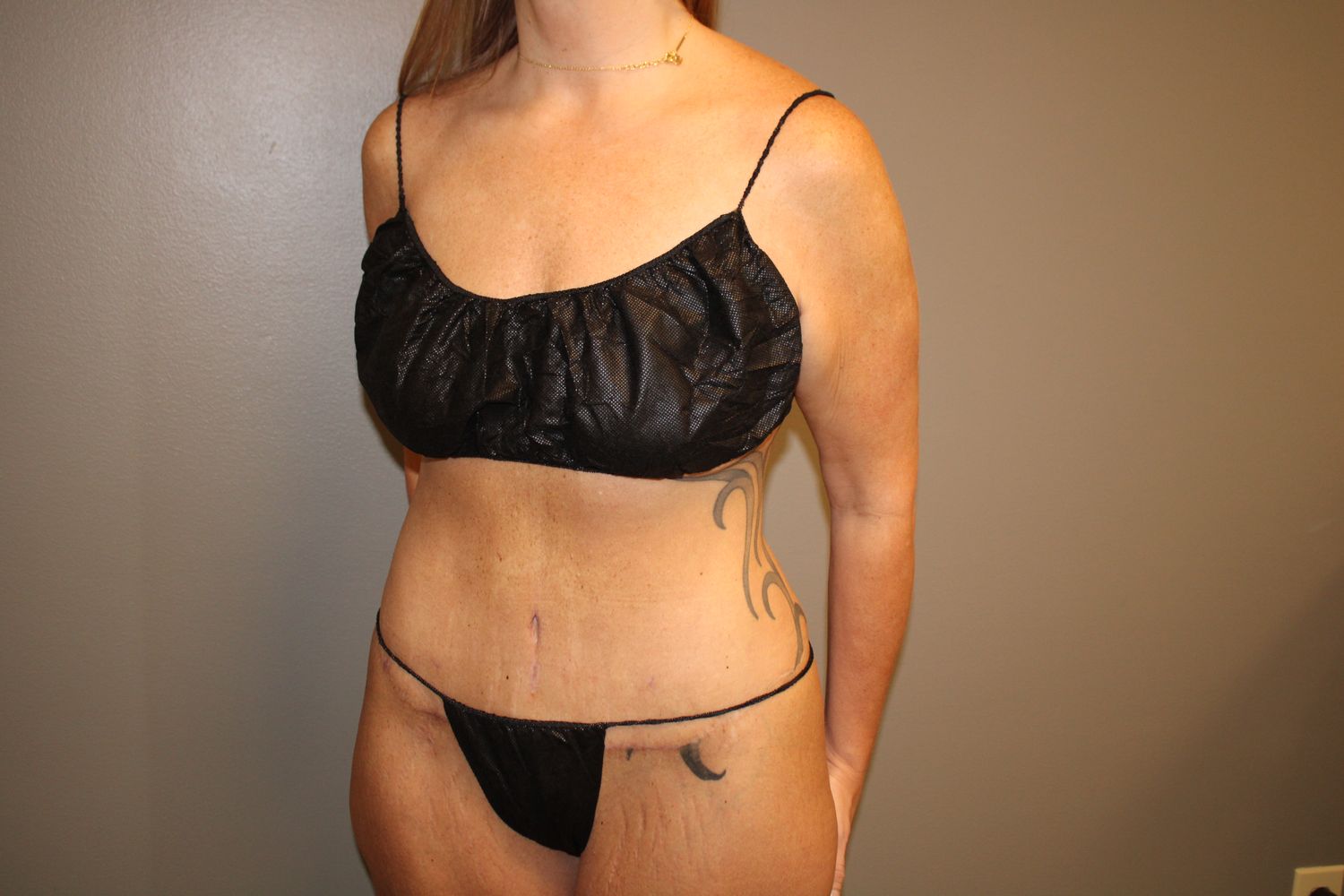 Tummy Tuck Before & After