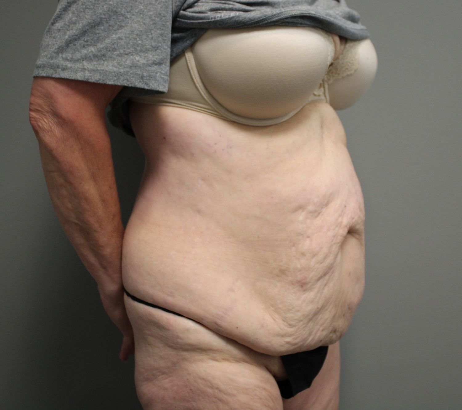 Tummy Tuck Before & After