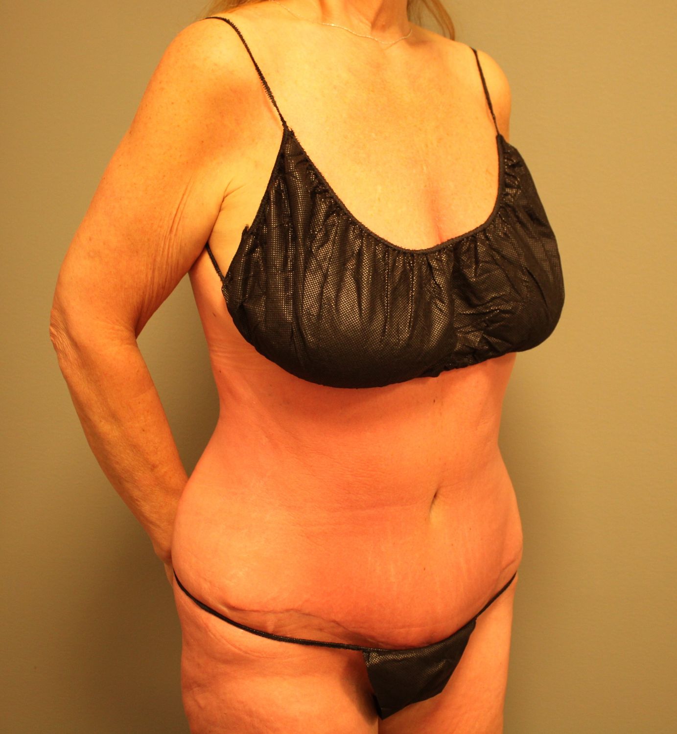 Tummy Tuck Before & After