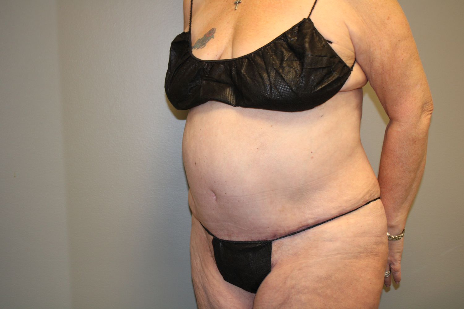 Tummy Tuck Before & After