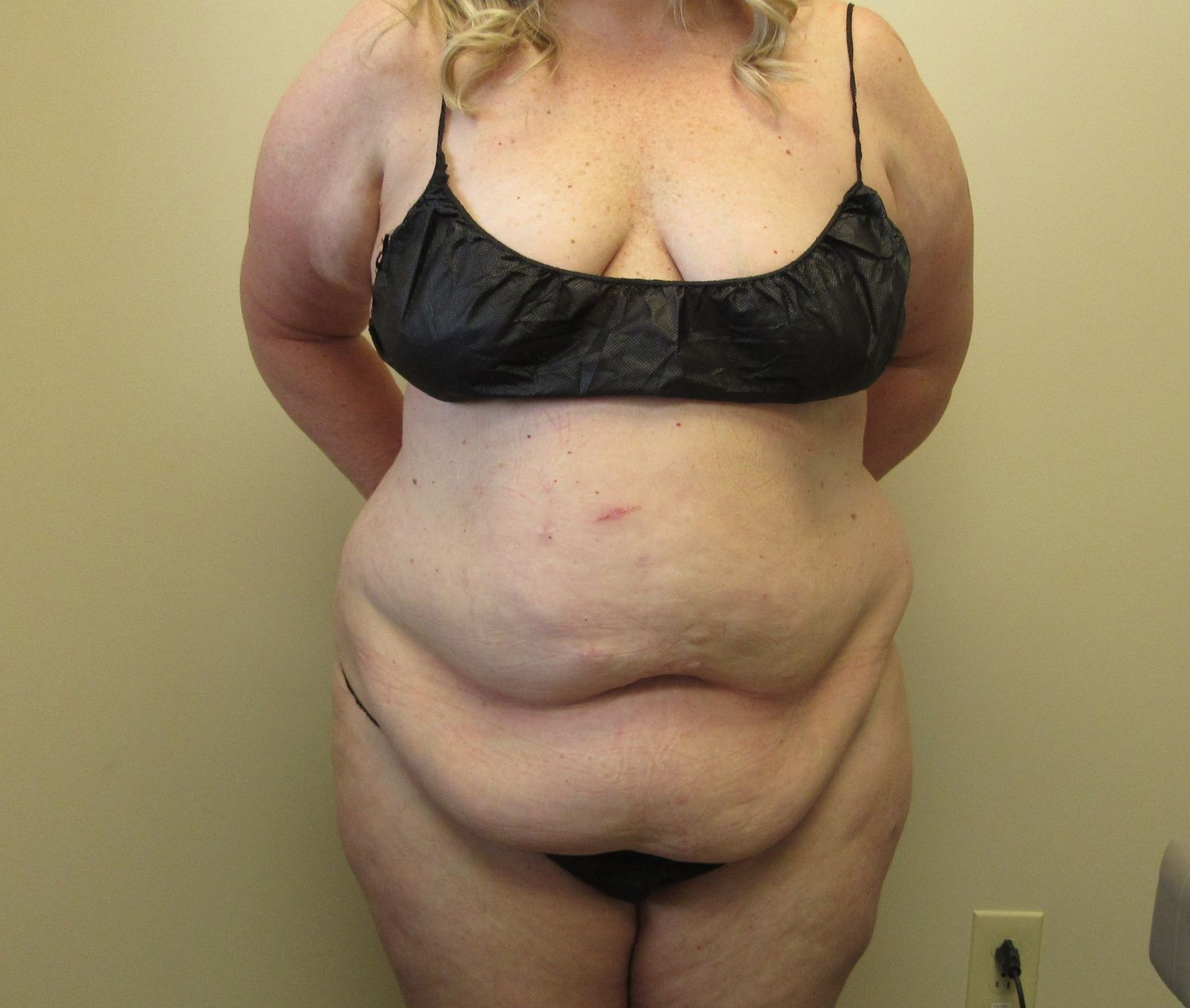 Tummy Tuck Before & After