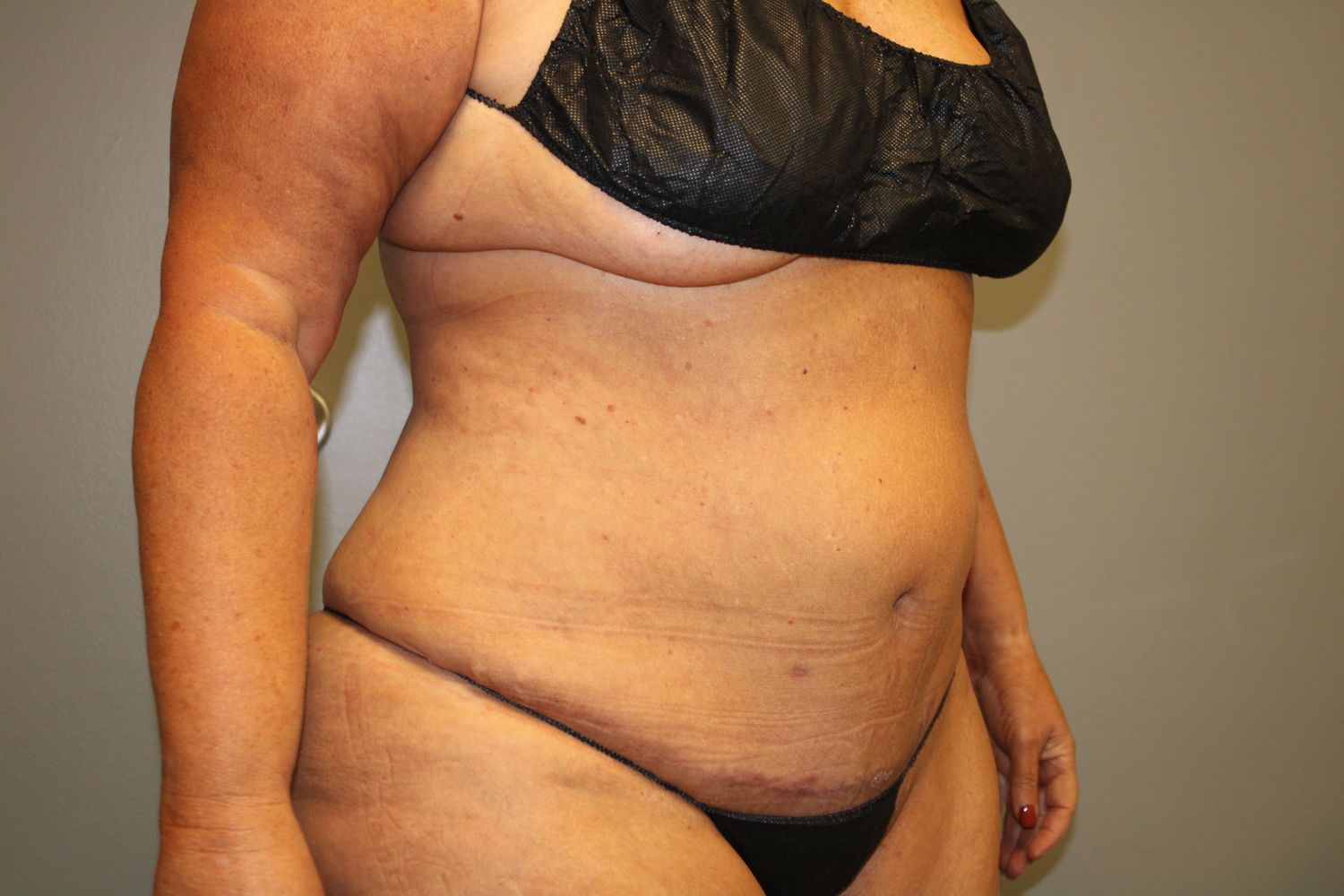 Tummy Tuck Before & After