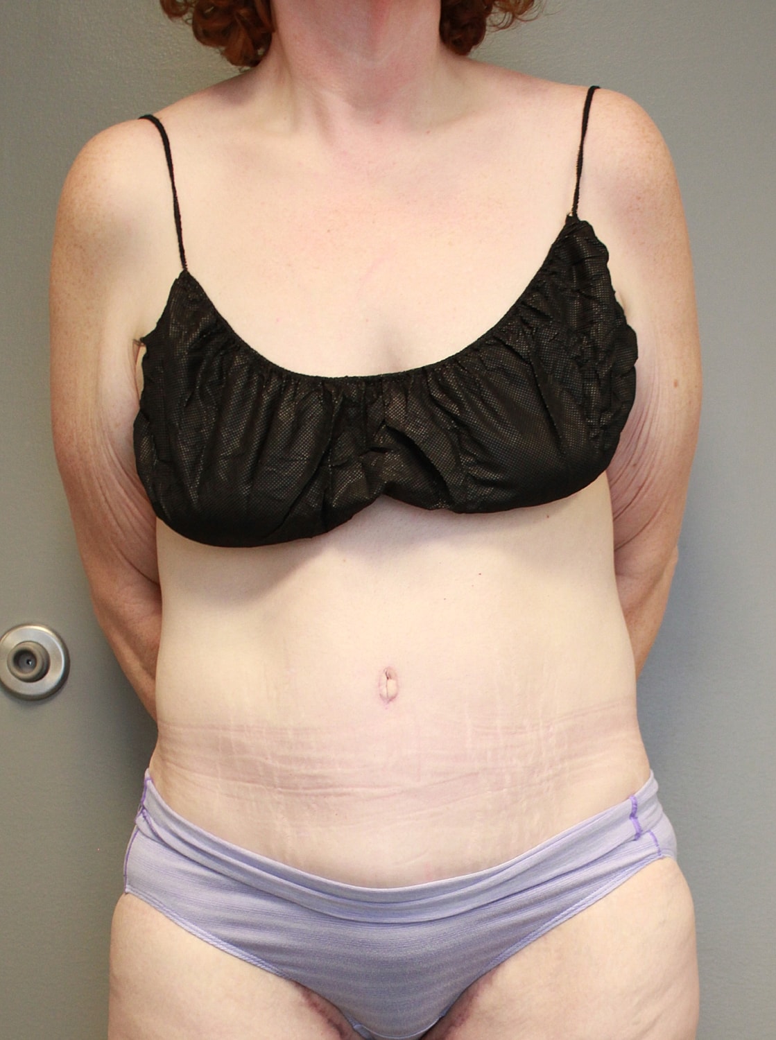 Tummy Tuck Before & After