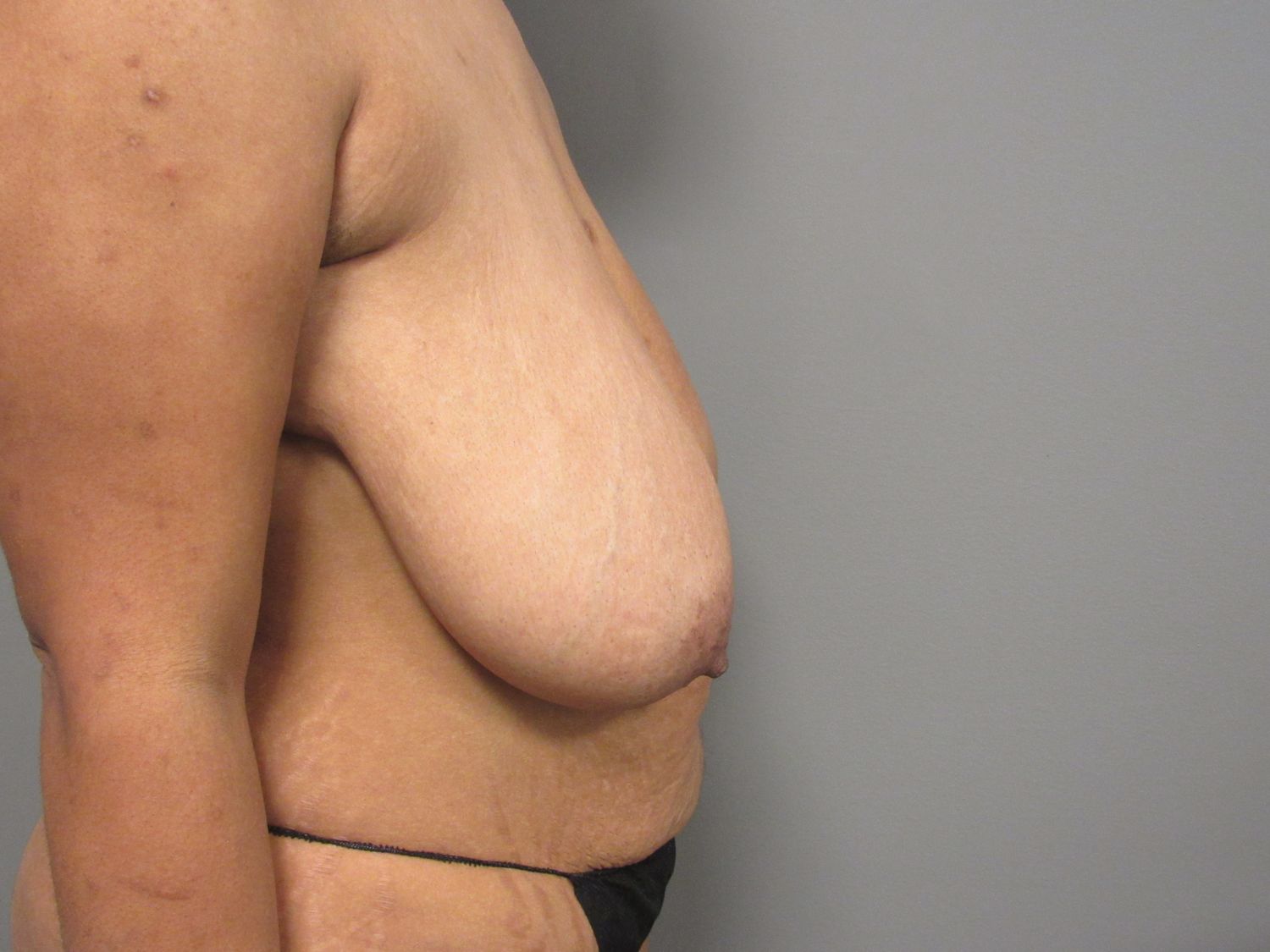 Breast Reduction Before & After