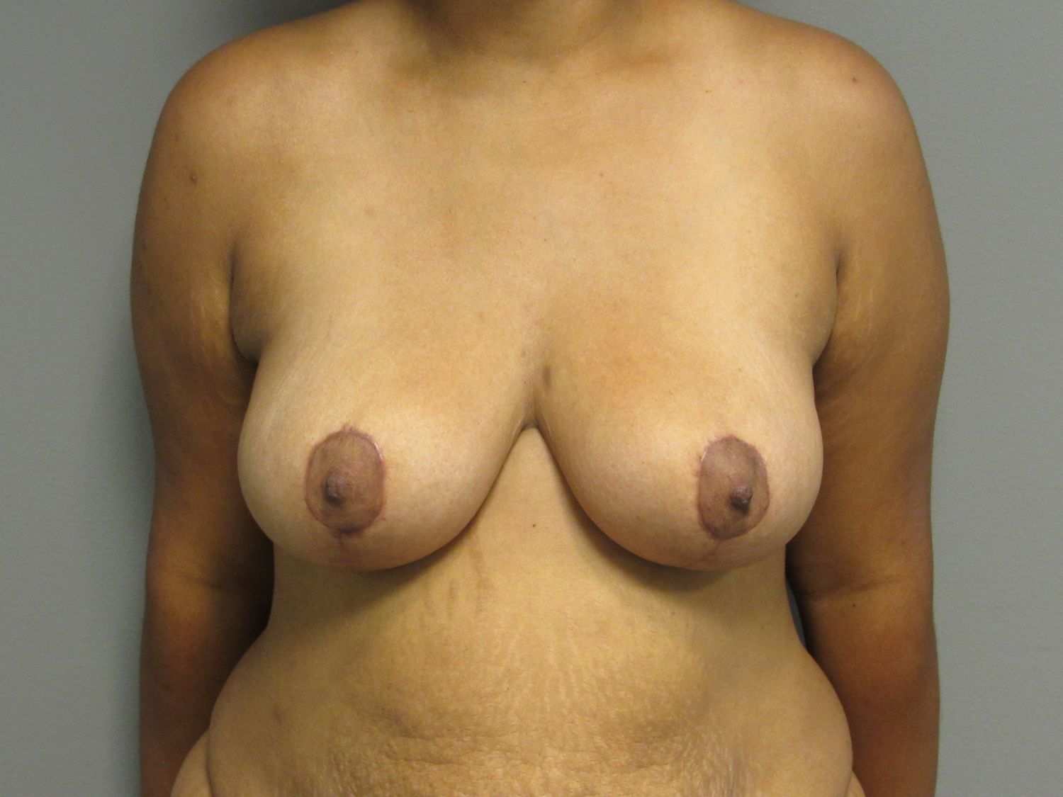 Breast Reduction Before & After