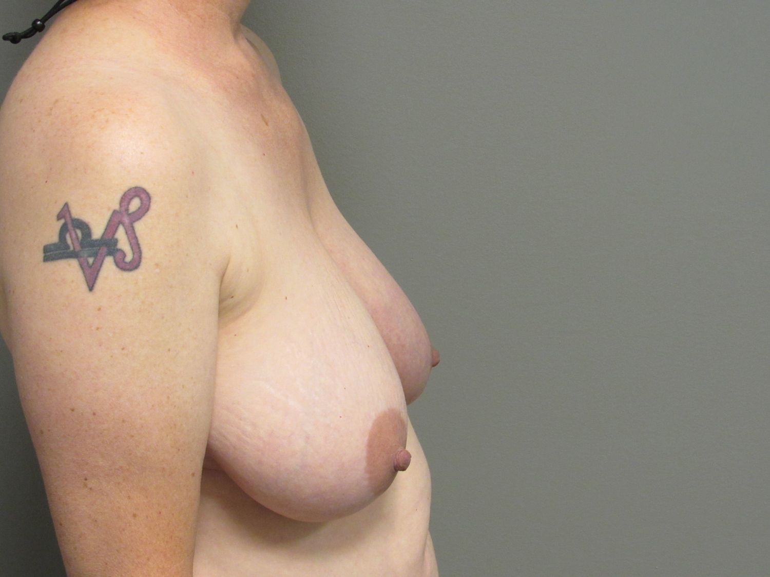 Breast Reduction Before & After