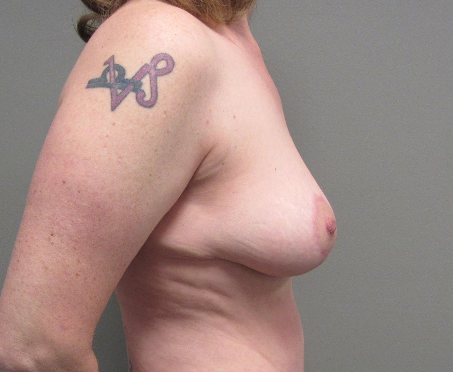 Breast Reduction Before & After