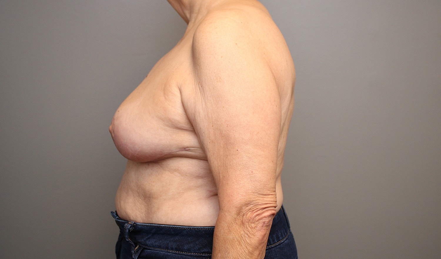 Breast Reduction Before & After