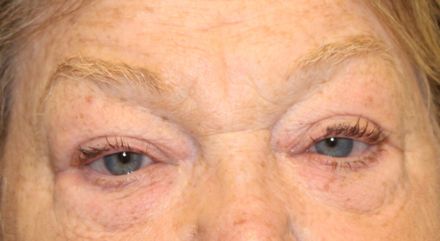 Blepharoplasty Before & After