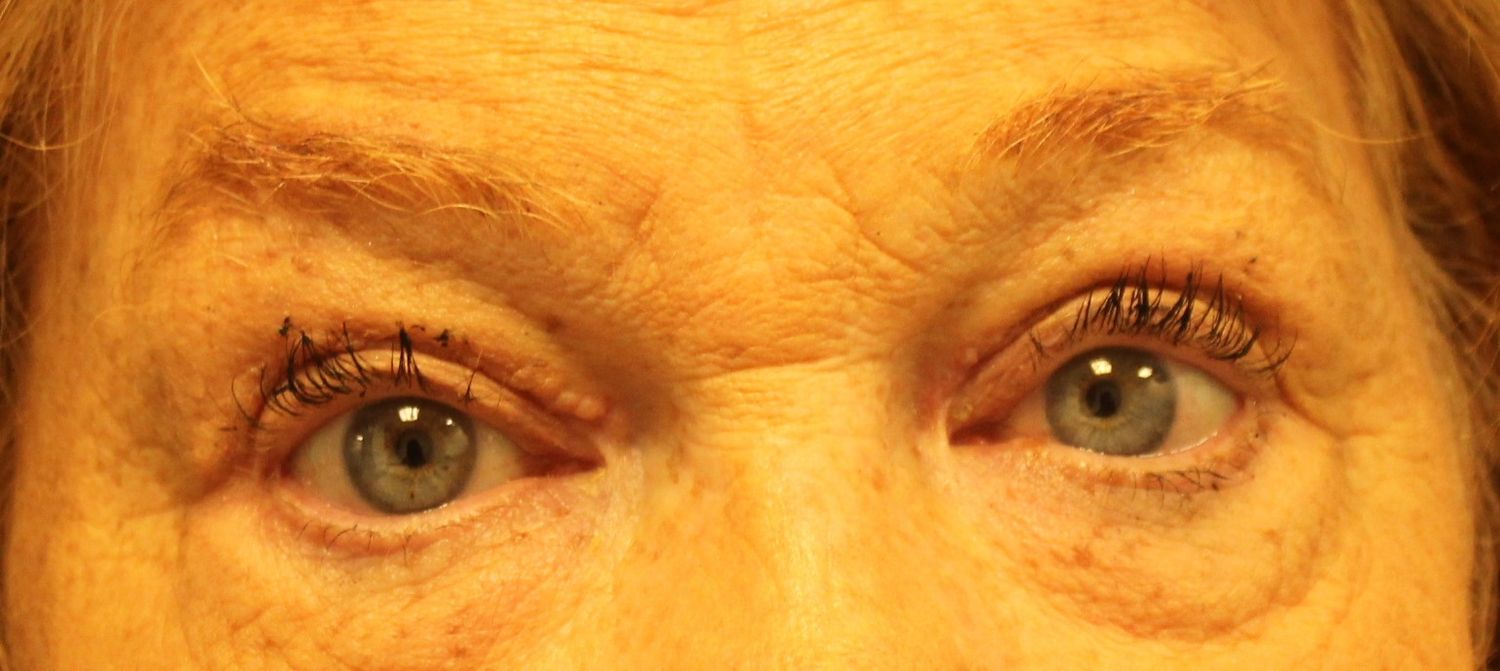 Blepharoplasty Before & After