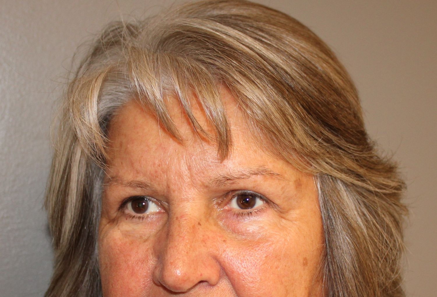 Blepharoplasty Before & After