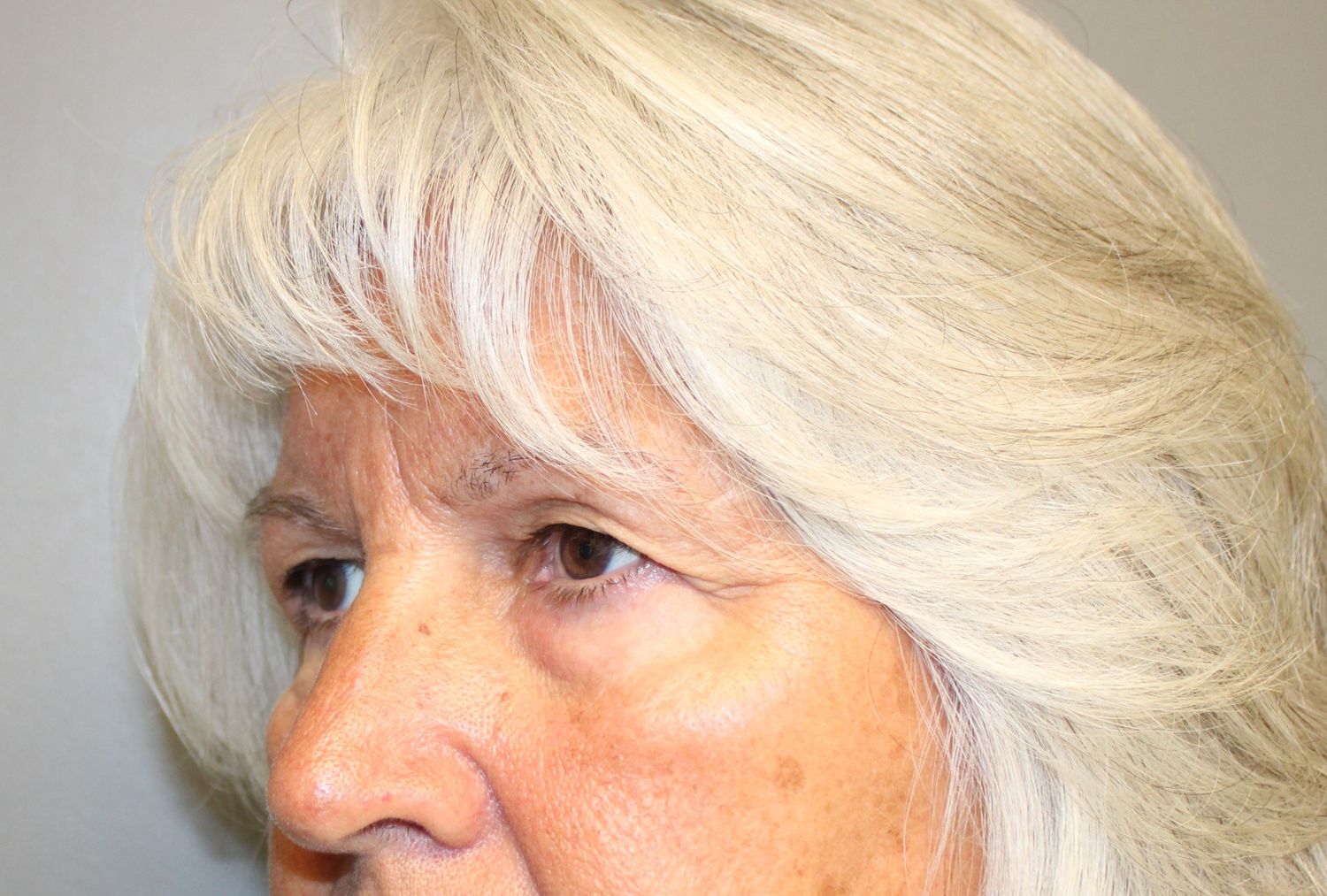 Blepharoplasty Before & After