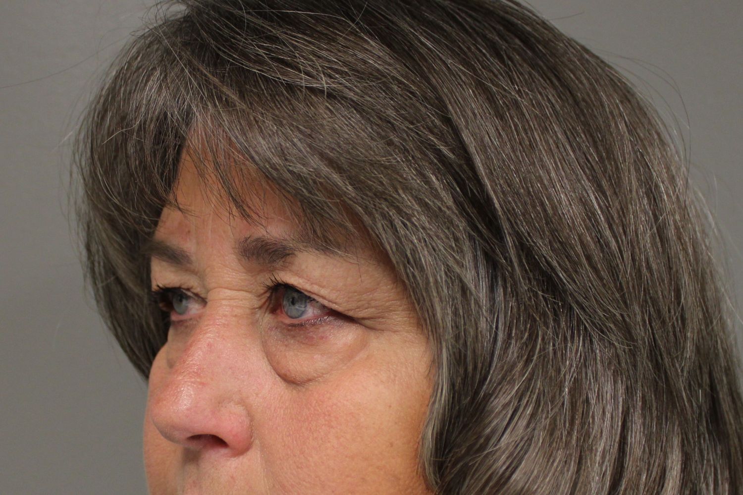 Blepharoplasty Before & After