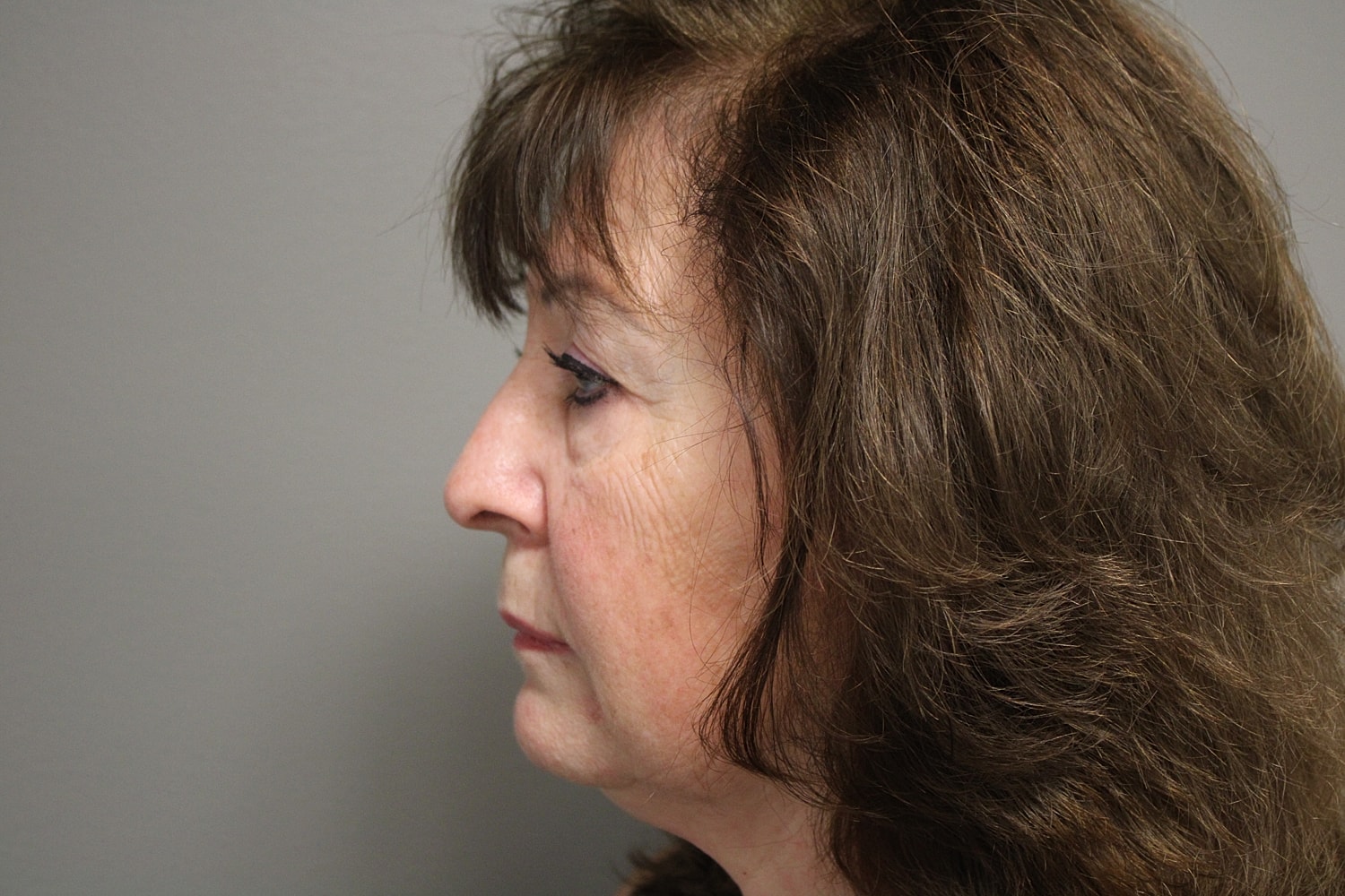 Blepharoplasty Before & After