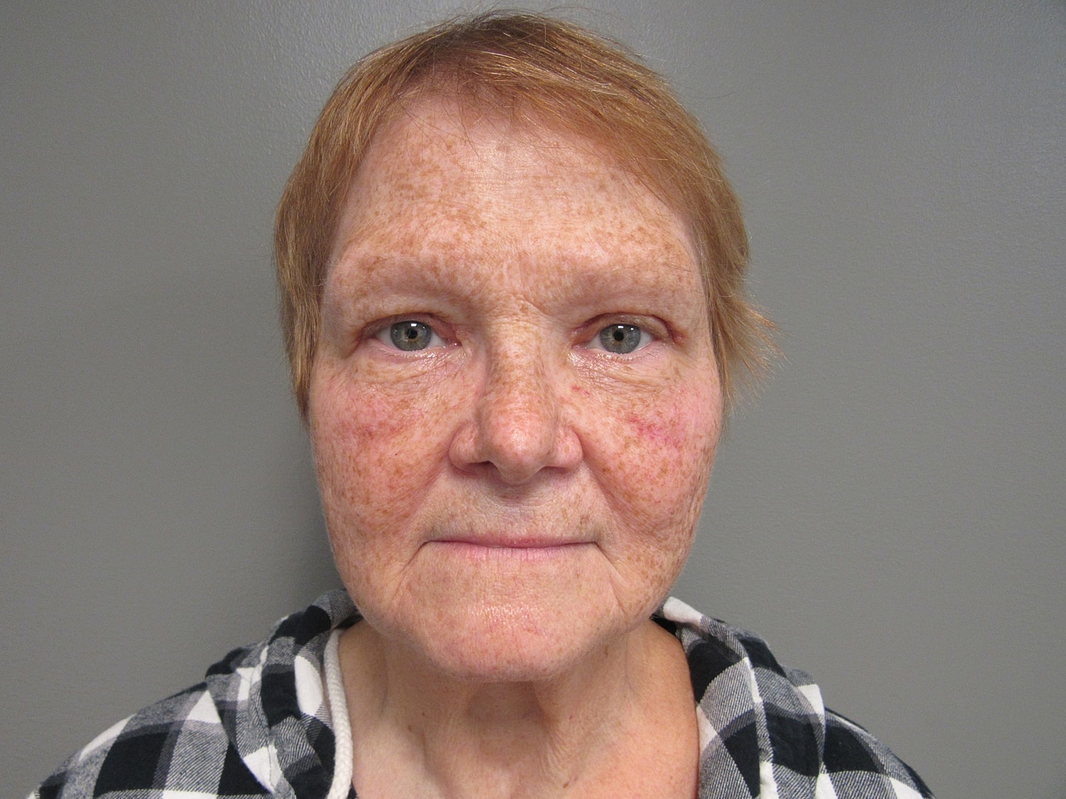 Blepharoplasty Before & After