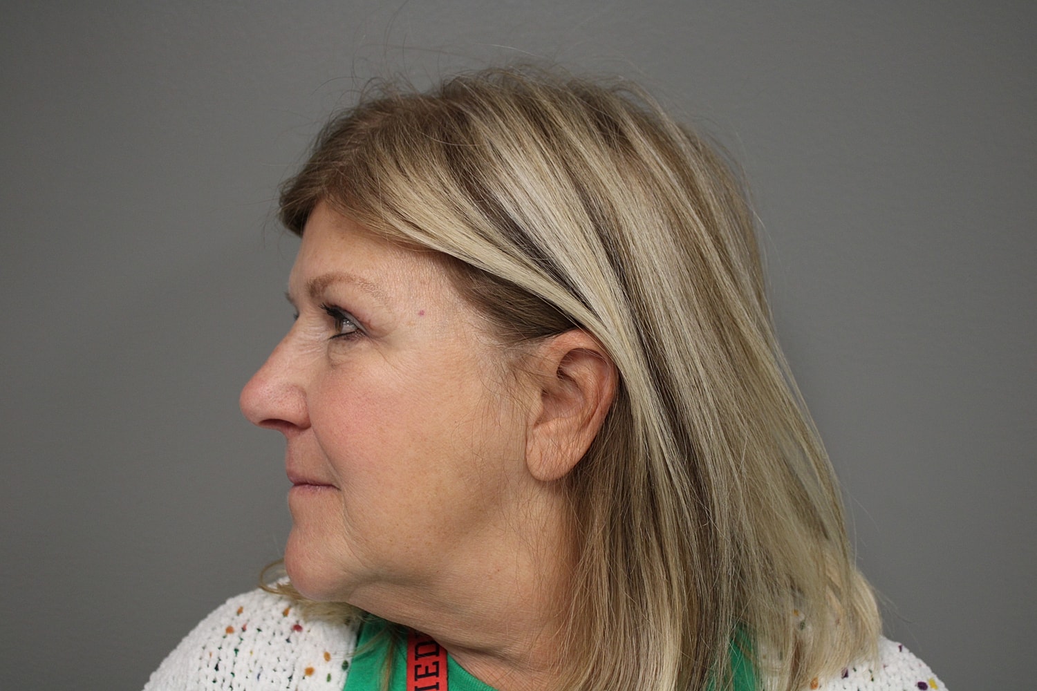 Blepharoplasty Before & After