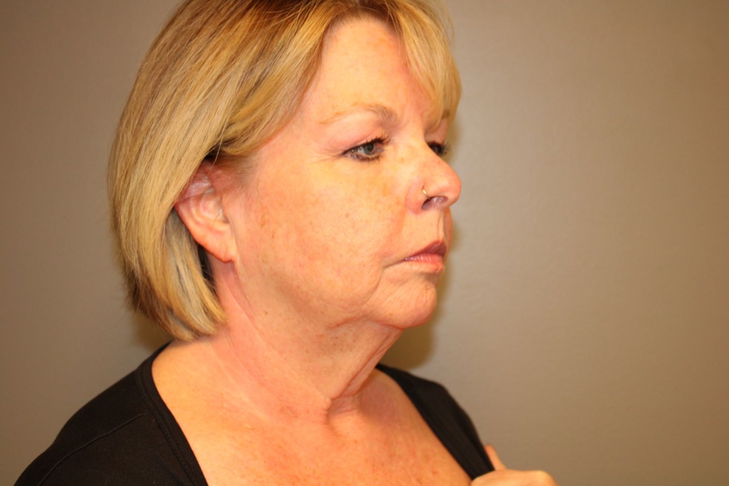 Facelift Before & After