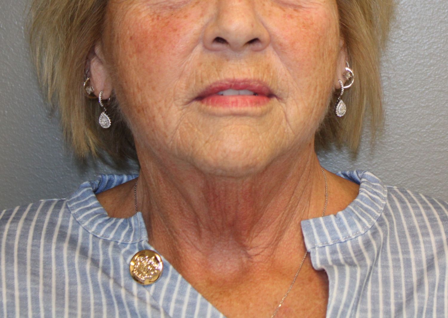 Facelift Before & After