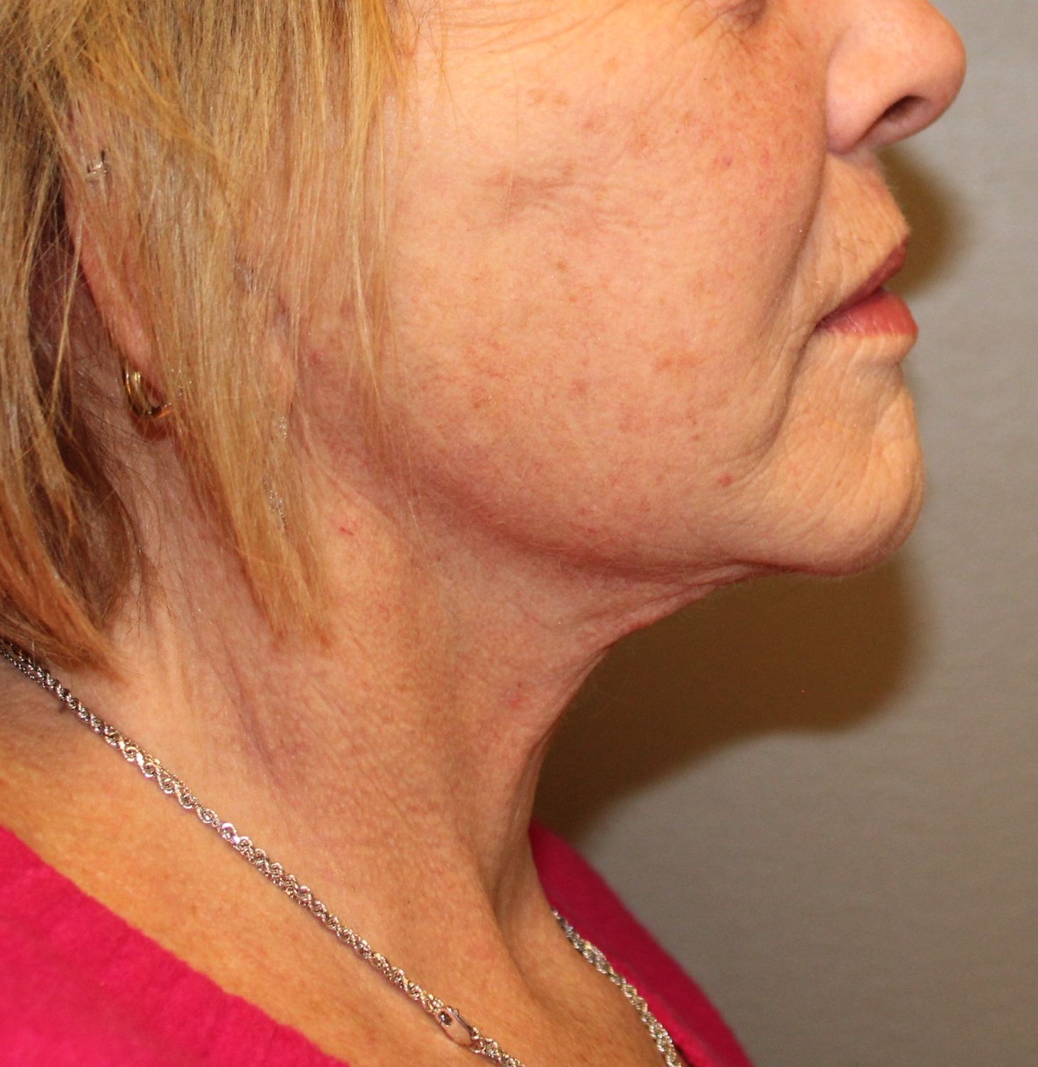 Facelift Before & After