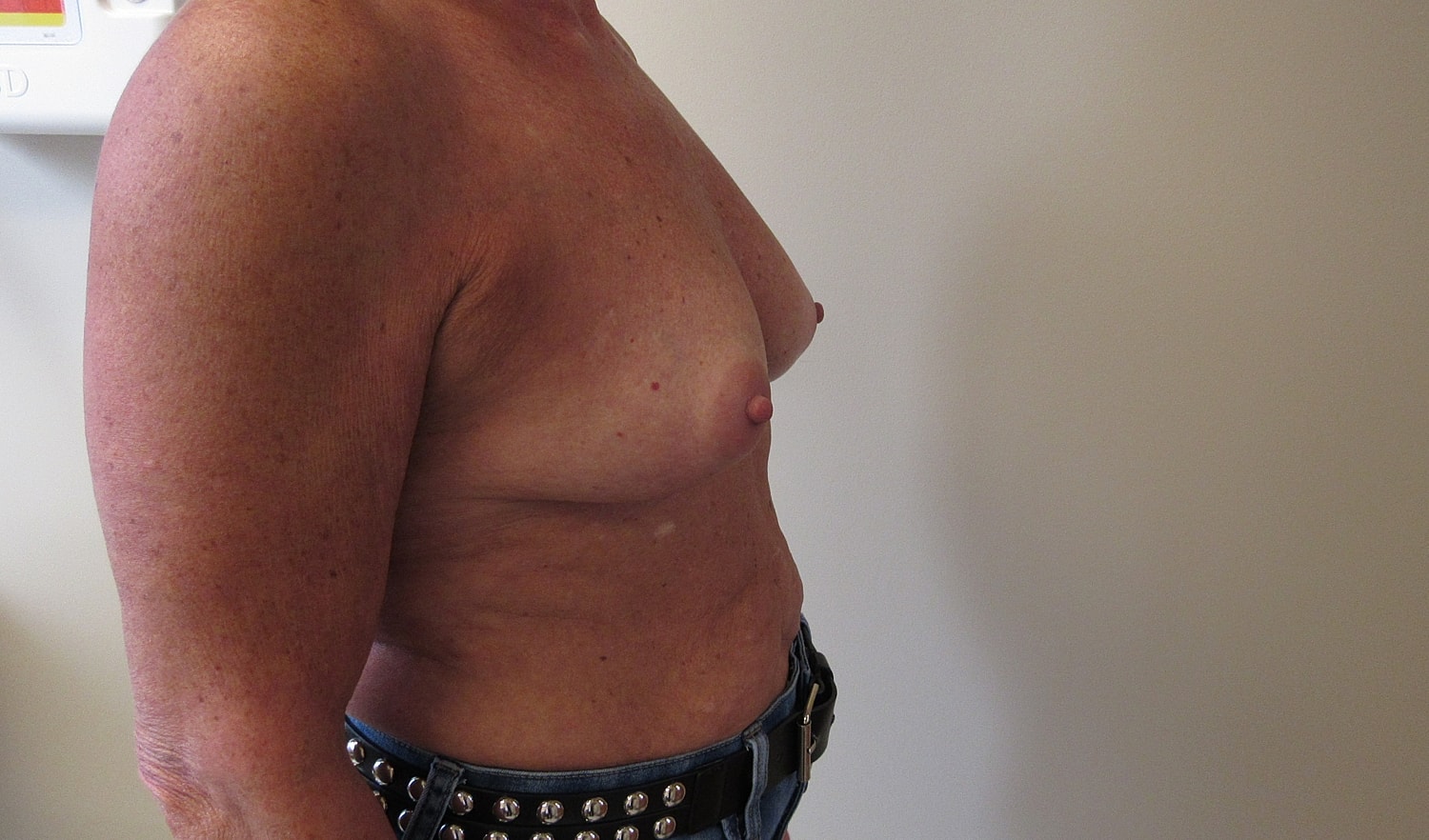 Breast Augmentation Before & After